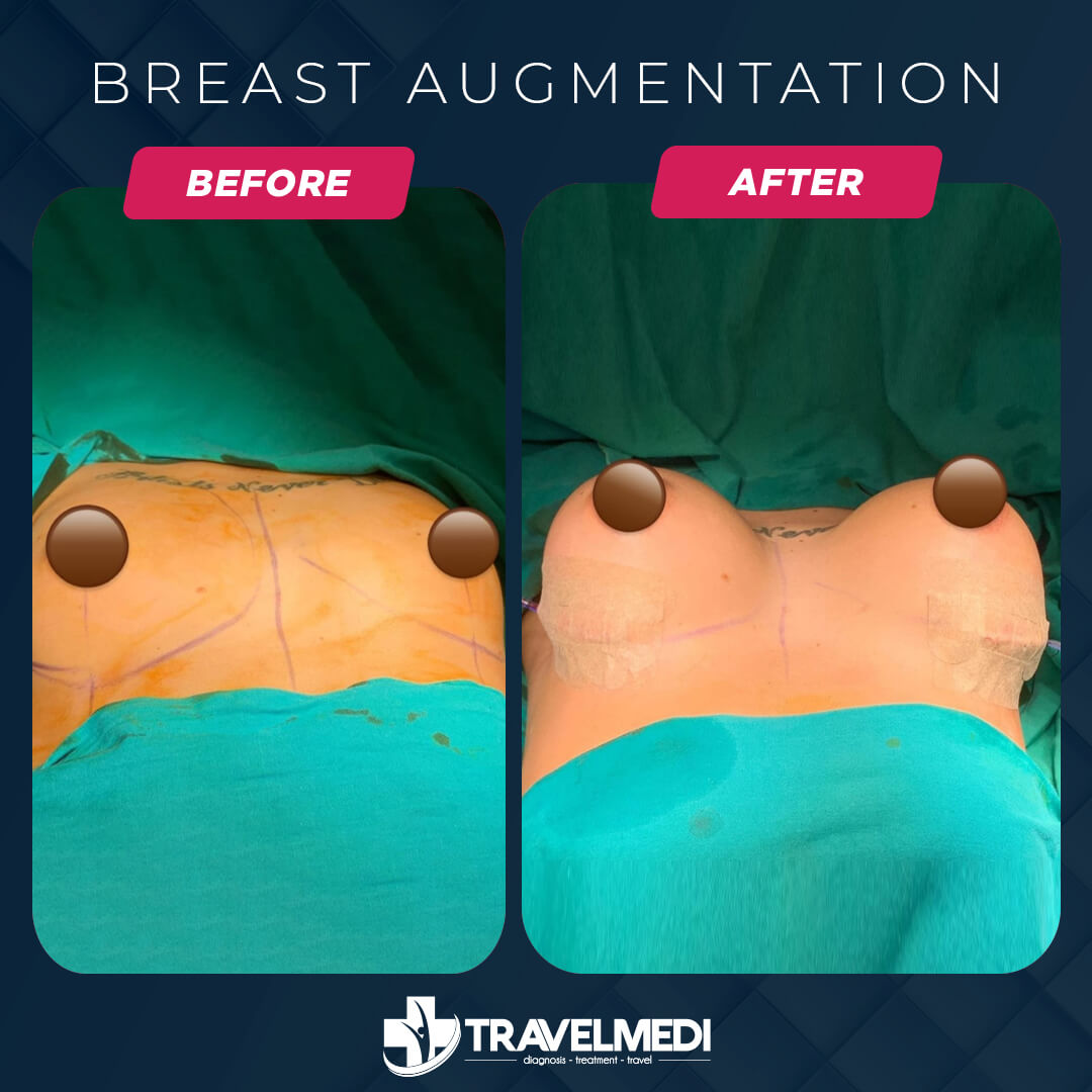 Breast Augmentation in Turkey Before After