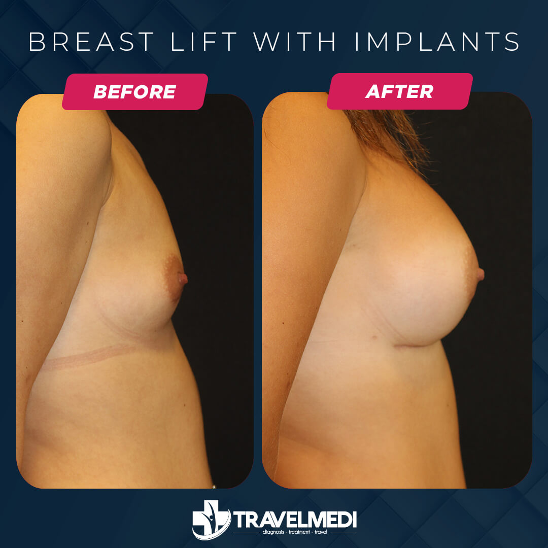 Breast Lift Turkey Before After