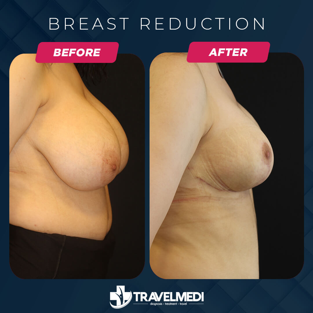 Breast reduction before after in Turkey