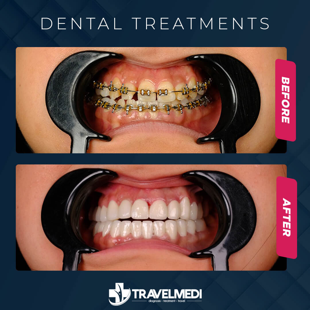 Dental treatments before after in Turkey