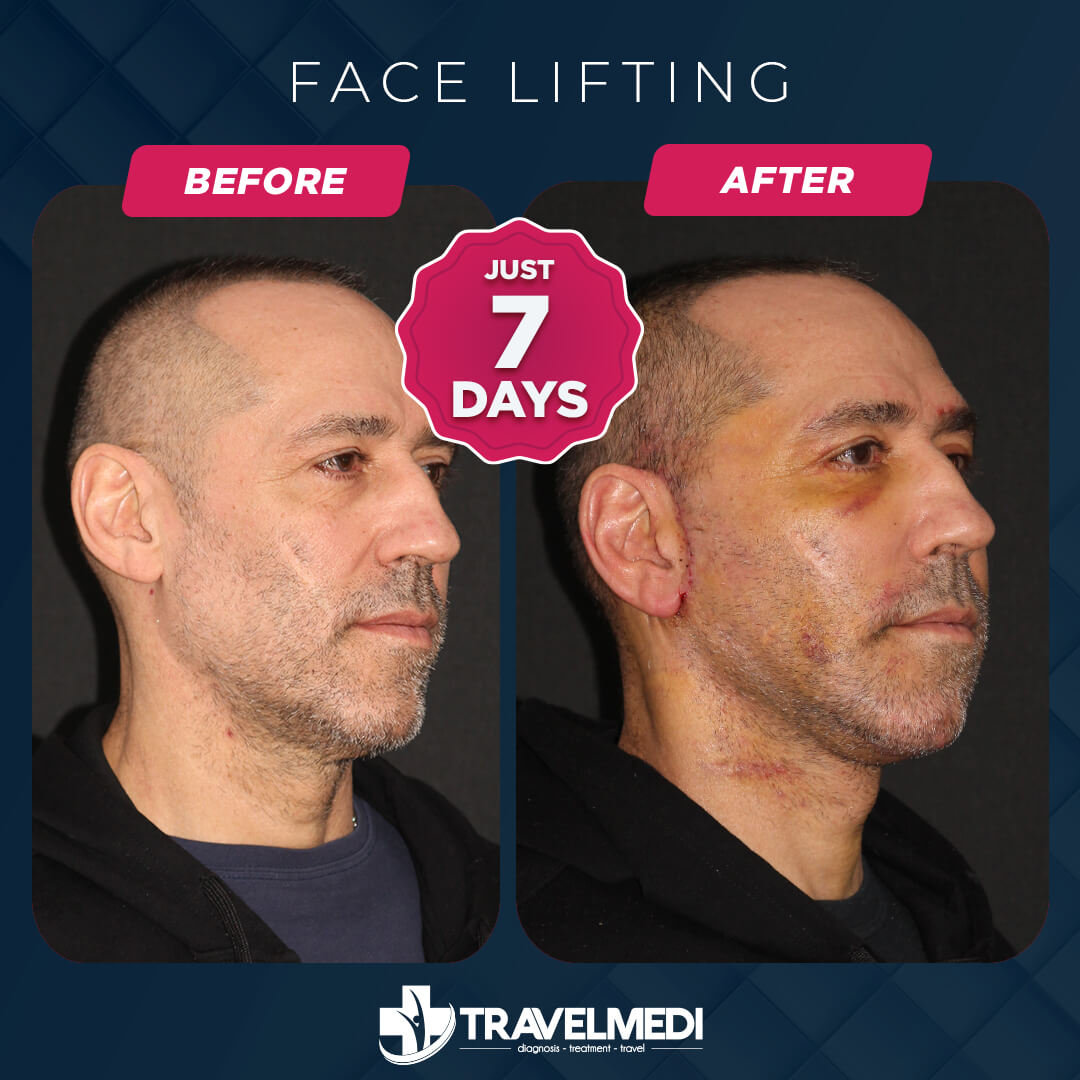 Facelift before after in Turkey