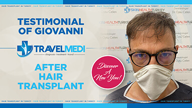 Giovanni video testimony after hair transplant operation