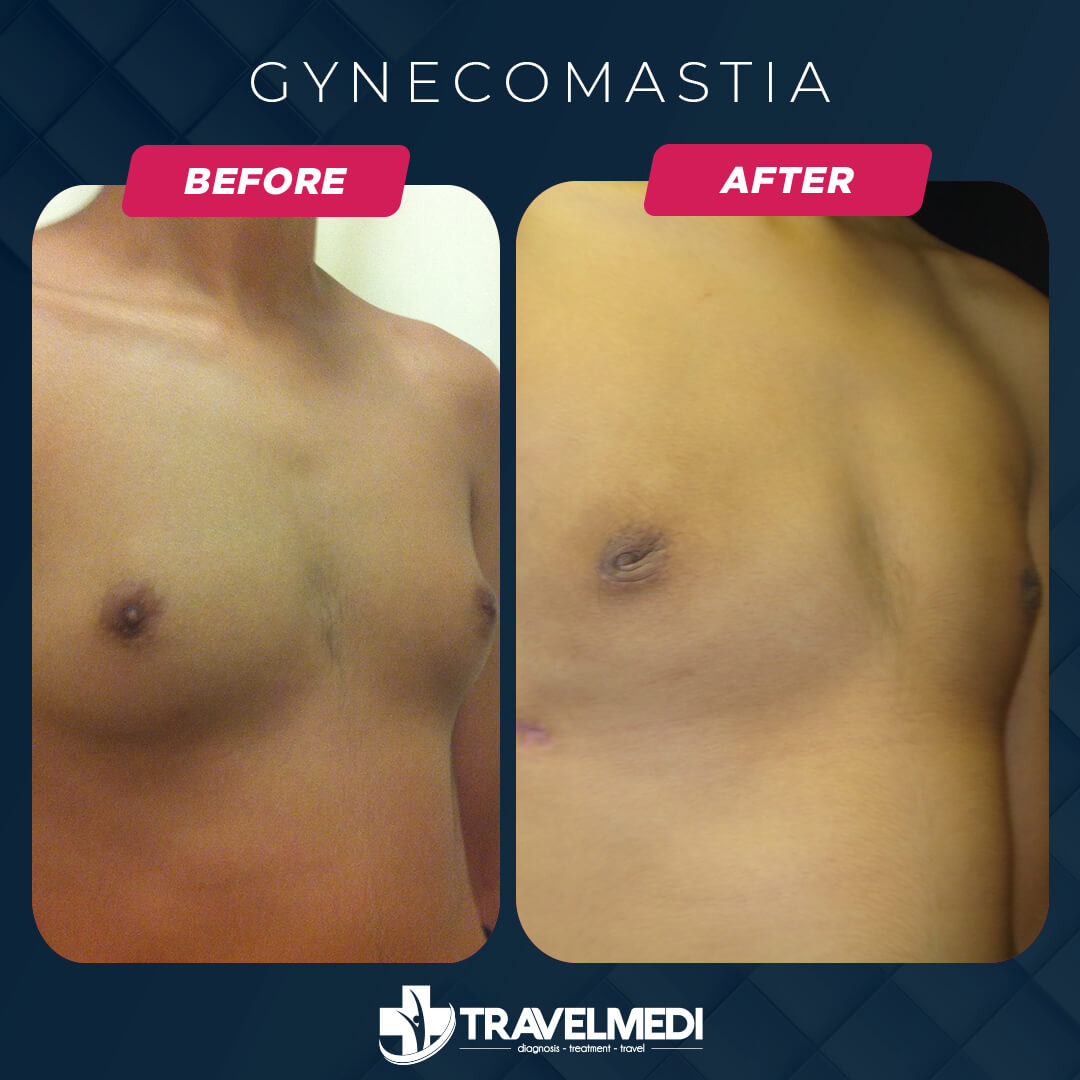 Gynecomastia before after in Turkey