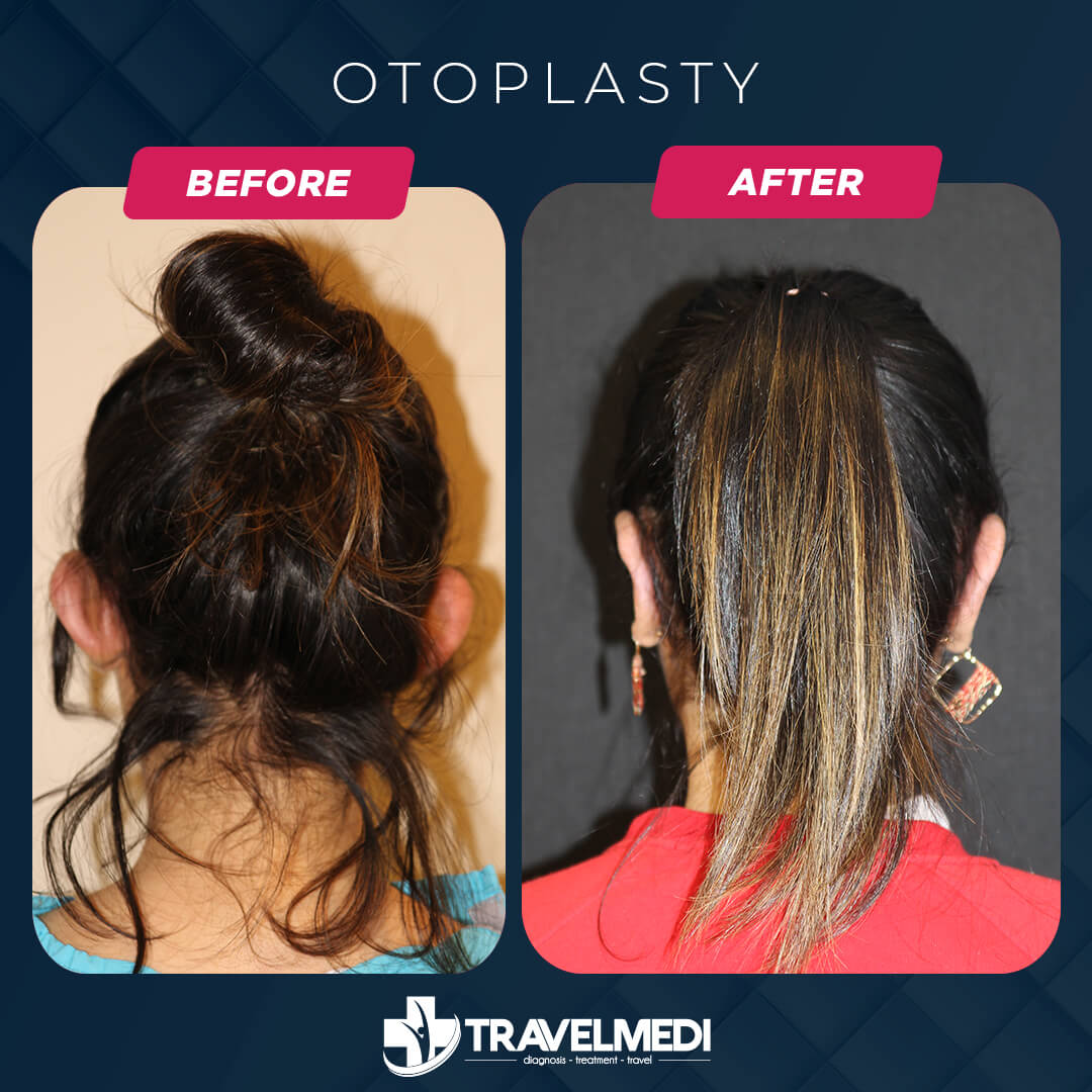 Otoplasty (Prominent Ear Surgery) before after in Turkey