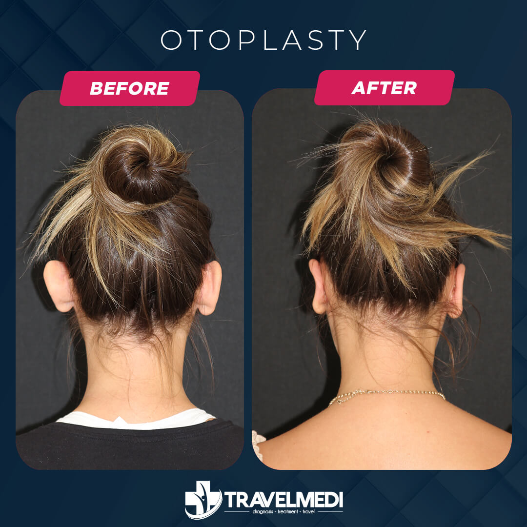 Otoplasty (Prominent Ear Surgery) before after in Turkey