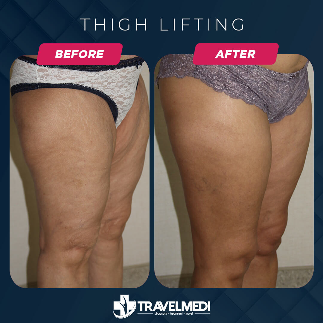 Thigh Lift before after in Turkey