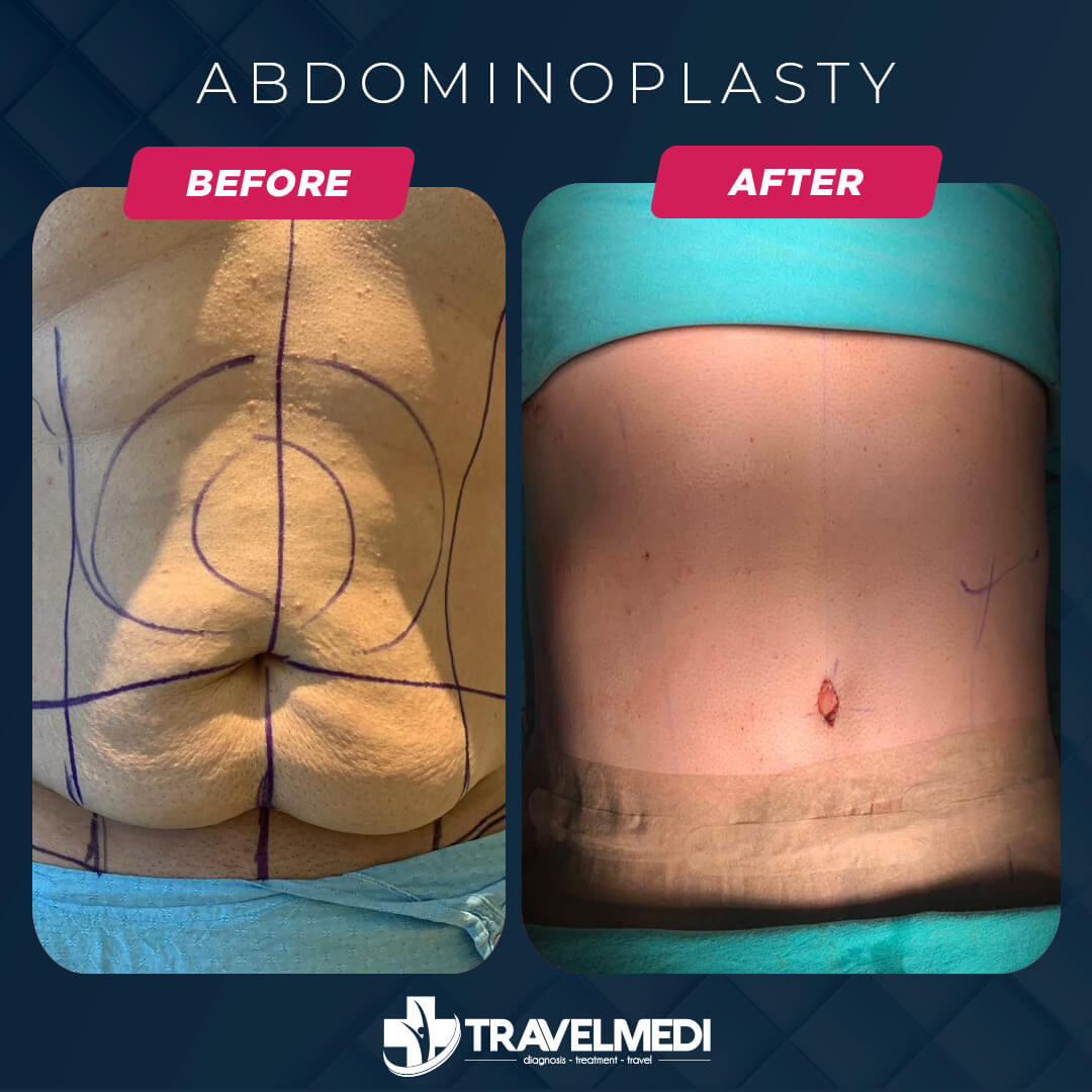 Tummy Tuck before after in Turkey